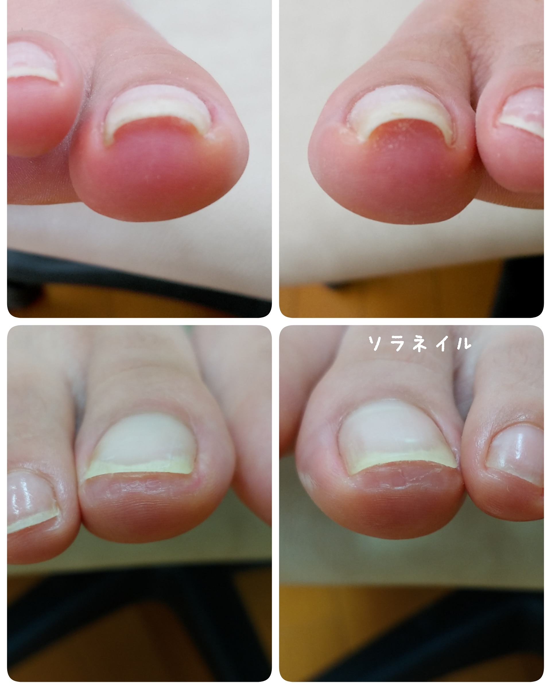 巻き爪ケアのオフ フットケア ソラネイル 川越市にある爪の専門店